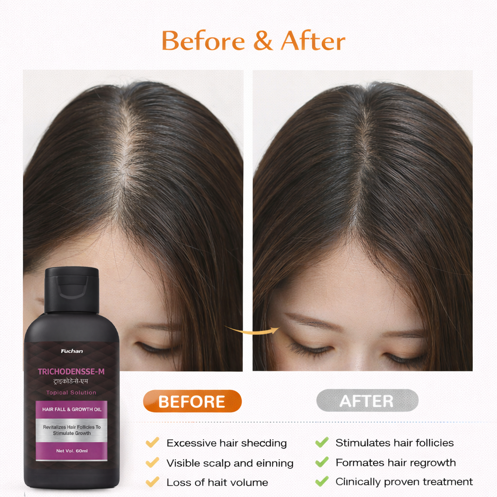Trichodensse M Topical Solution | Hair Fall Control & Hair Regrowth Treatment Trichodensse M Topical Solution | Hair Fall Control & Hair Regrowth Treatment