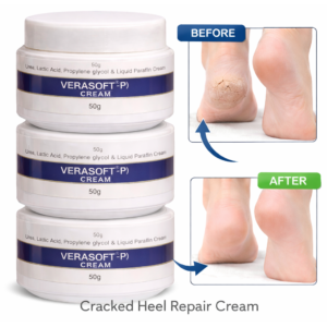 Verasoft-P Foot Care Cream | Soft Feet Cream | Verasoft P Cream | Verasoft-P Cream