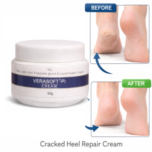 Verasoft-P Foot Care Cream | Soft Feet Cream | Verasoft P Cream | Verasoft-P Cream